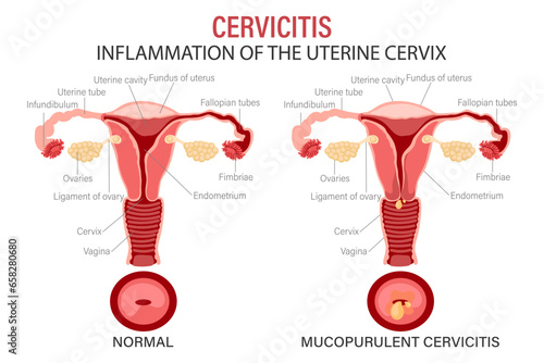 Cervicitis, diseases of the female reproductive system. Schematic representation of the uterus and cervix. Medical infographic banner. Vector