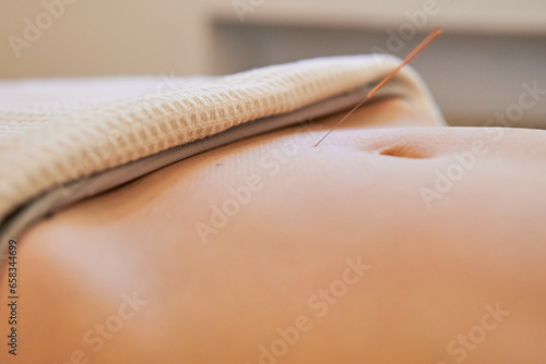 close up of acupuncture fertility treatment applied to the woman uterus area below the navel photo
