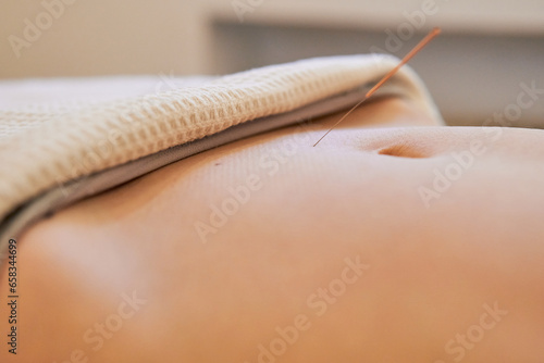 Tablou pe pânză close up of acupuncture fertility treatment applied to the woman uterus area bel