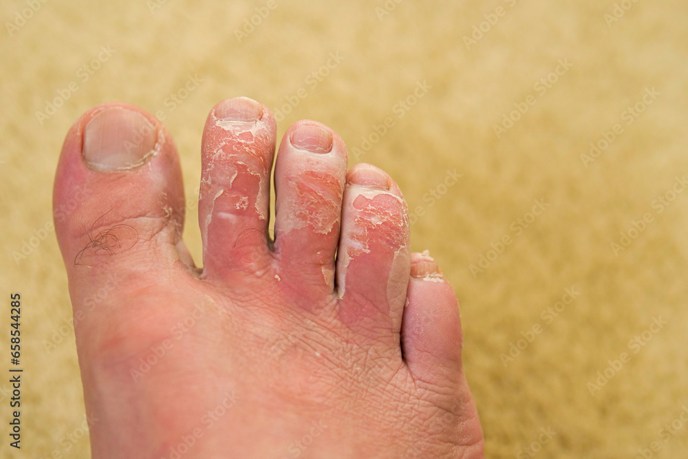 Close-up of the foot with fungal disease, deep scabbing on the toes,