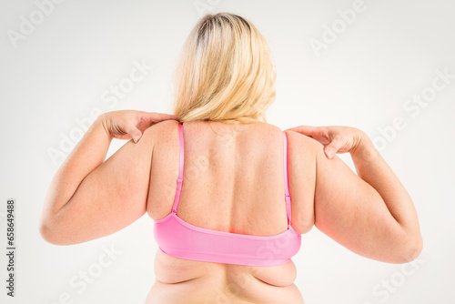 Overweight woman with fat hands and back, obesity female body on gray background photo