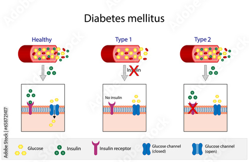 Diabetes mellitus type 1, pancreas's failure to produce enough insulin and type 2, cells fail to respond to insulin (Insulin resistance). Result in high blood glucose levels. Vector illustration