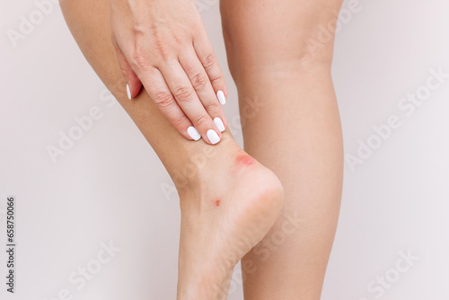 Fototapeta Naklejka Na Ścianę i Meble -  Callus on the heel from tight shoes. Cropped shot of a young woman touching her ankle with a sore with her hand on gray background. Corns, blisters on the foot