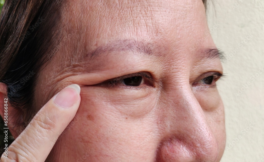 close up showing the fingers holding the flabbiness and wrinkle beside the eyelid, dark spots and blemish on the face of the woman, health care and beauty concept. close up showing the fingers holding the flabbiness and wrinkle beside the eyelid, dark spots and blemish on the face of the woman, health care and beauty concept.