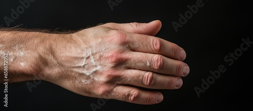 Man with autoimmune genetic dermatology disease experiencing dry flaky skin on hand due to conditions such as psoriasis vulgaris eczema fungus plaque rash and patches With copyspace for tex photo