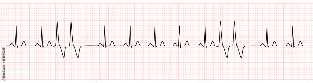 EKG Monitor Showing  Sinus Rhythm with Couplets PVC