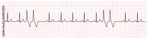 EKG Monitor Showing  Sinus Rhythm with Couplets PVC