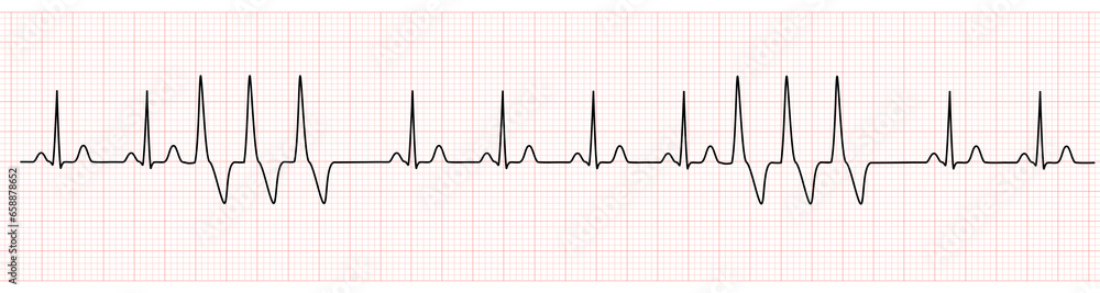 EKG Monitor Showing  Sinus Rhythm with Short Run VT