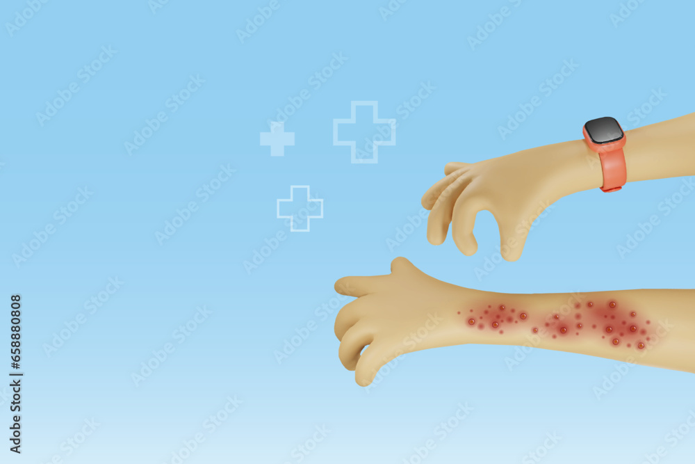 Hand suffering from raches, red blisters skin diseases. Chicken pox