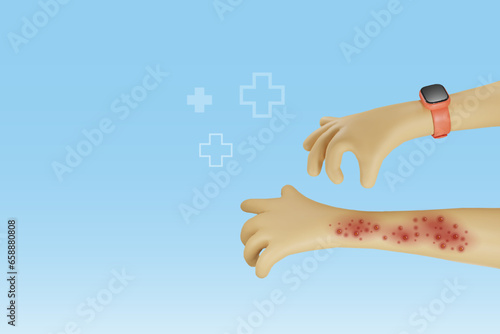 Hand suffering from raches, red blisters skin diseases. Chicken pox, monkey pox, orthopox virus outbreak. Medical and dermatitis skin care. Vector 3D cartoon character.  photo
