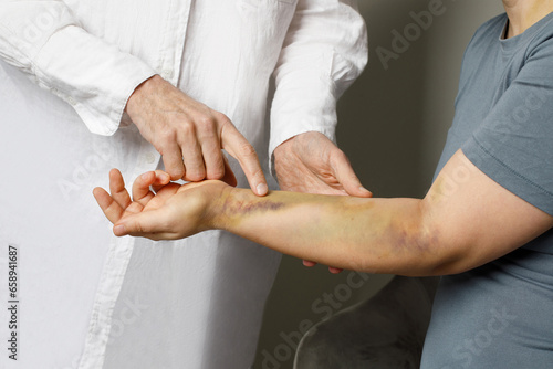 Doctor examining bruises on her patient's arm. Medicine and treatment concept photo