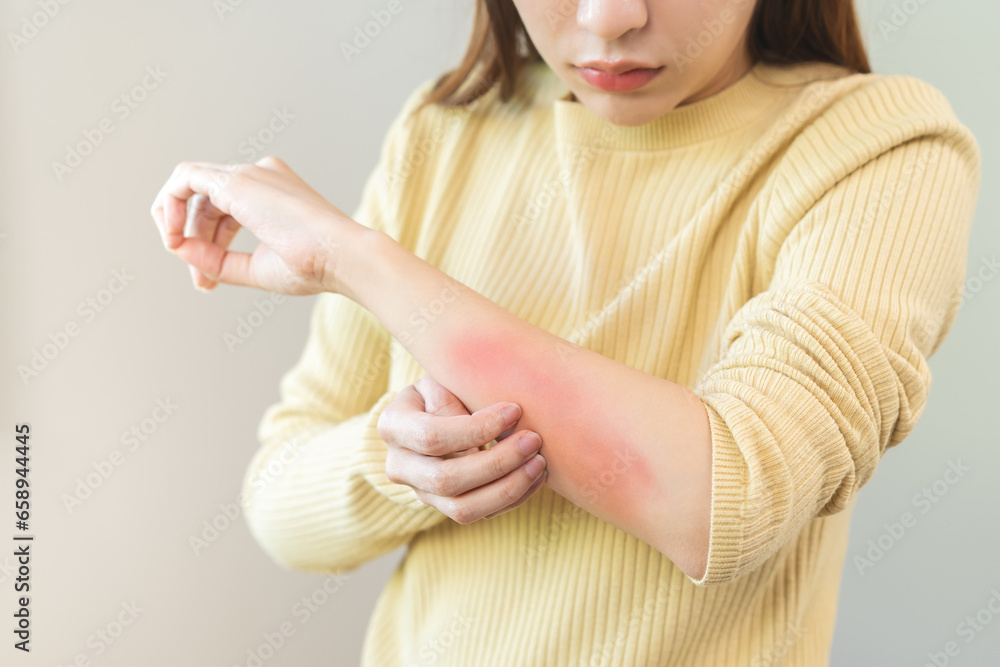 Naklejka premium Dermatology asian young woman, girl allergy, allergic reaction from atopic, insect bites on her arm, hand in scratching itchy, itch red spot or rash of skin. Healthcare, treatment of beauty.