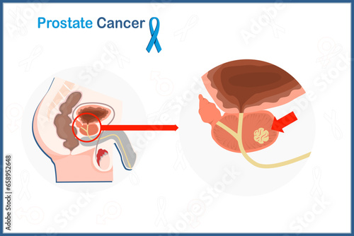 Flat medical illustration concept of prostate cancer. Male reproductive system and prostate cancer.