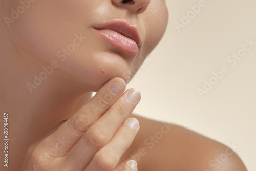 Skin problem close-up. Depressed woman touching pimple on face looking at mirror on her chin. Facial skin issues  medical care  and treatment concept. Selective Focus. High-quality photo