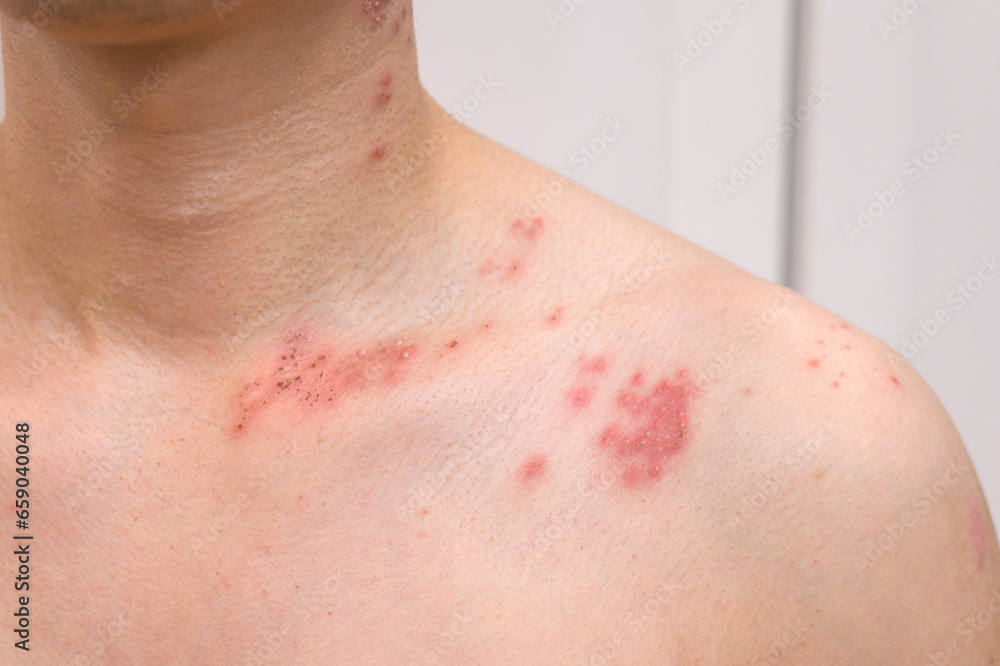 close up of man with shingles disease on skin close up of man with shingles disease on skin