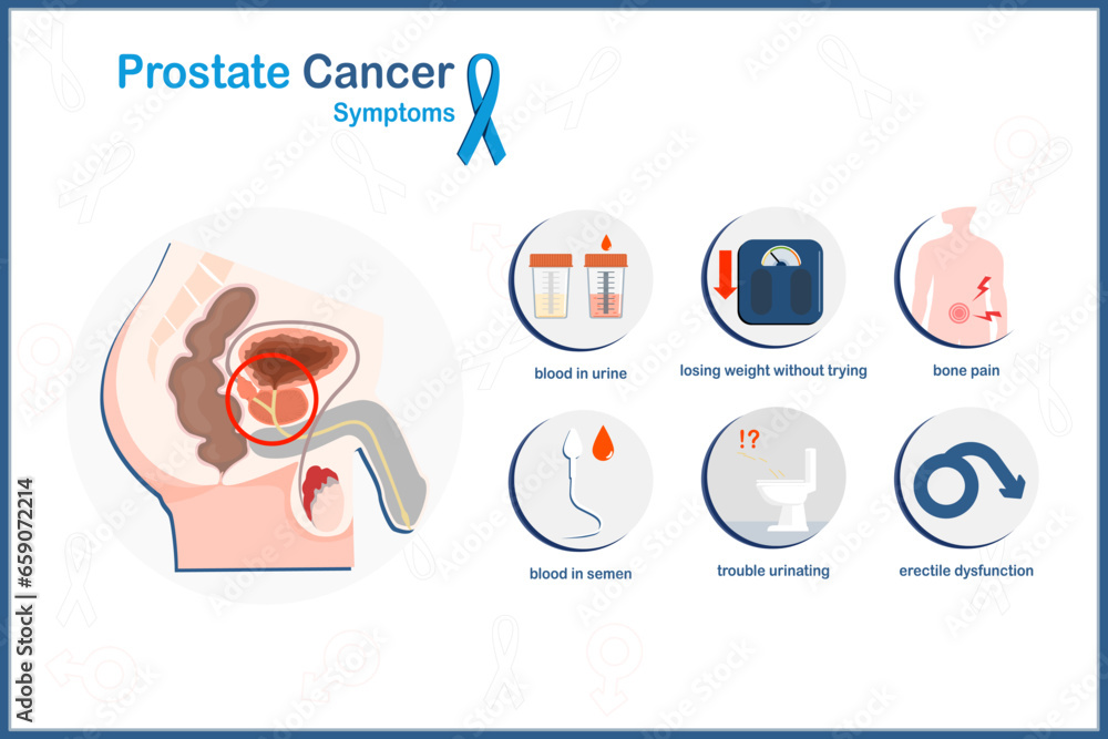 Vector medical illustration in flat style, prostate cancer concept.Prostate cancer symptoms.trouble urinating,bone pain,weight loss,blood in urine and semen,erectile dysfunction.flat style. - obrazy, fototapety, plakaty 
