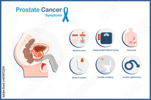 Vector medical illustration in flat style, prostate cancer concept.Prostate cancer symptoms.trouble urinating,bone pain,weight loss,blood in urine and semen,erectile dysfunction.flat style. photo