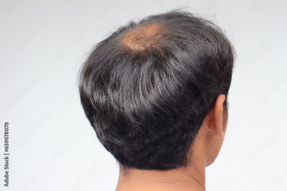 male head with bald head, hair loss, thinning hair or alopecia male head with bald head, hair loss, thinning hair or alopecia