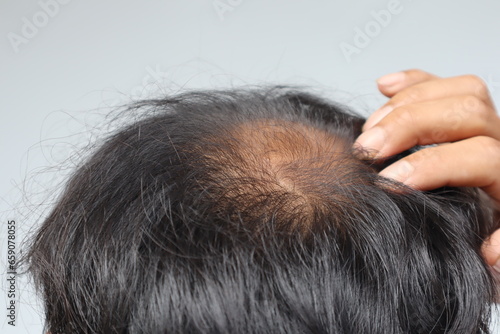 male head with bald head, hair loss, thinning hair or alopecia