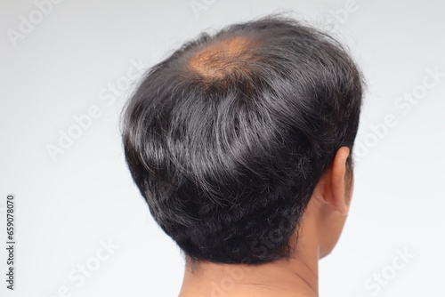 male head with bald head, hair loss, thinning hair or alopecia