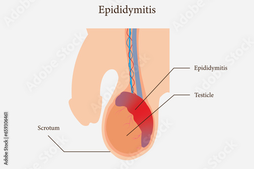 illustration of epididimitis (inflamasi epididimis). Epididymitis is inflammation of the epididymis which is generally caused by a bacterial infection. eps 10
