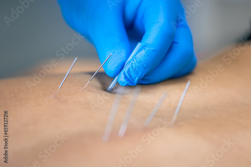 Close up of a needle and hands of physiotherapist doing a dry needling.