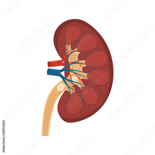 Urological diseases concept. Human kidney stones vector illustration