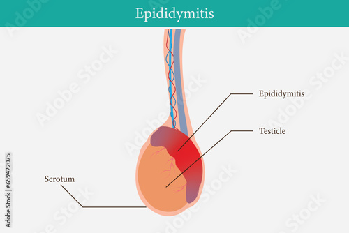 illustration of epididimitis (inflamasi epididimis). Epididymitis is inflammation of the epididymis which is generally caused by a bacterial infection. vector illustration. eps 10
