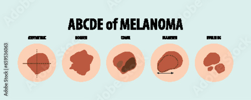 Illustrated Guide to Five Types of Skin Cancer