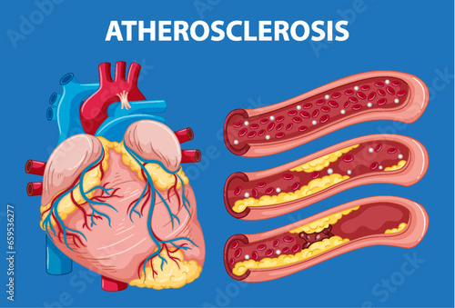 Science Education on Human Anatomy and Atherosclerosis Development