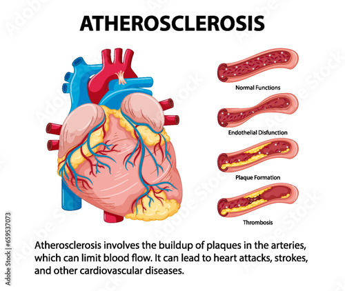 Science Education: Human Anatomy and Atherosclerosis Infographic