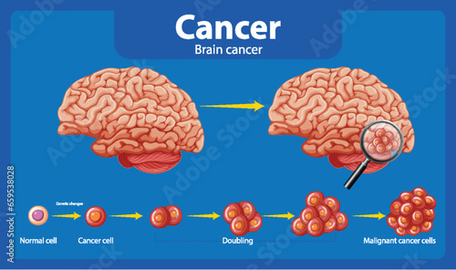Brain Cancer and Abnormal Cell Growth Infographic
