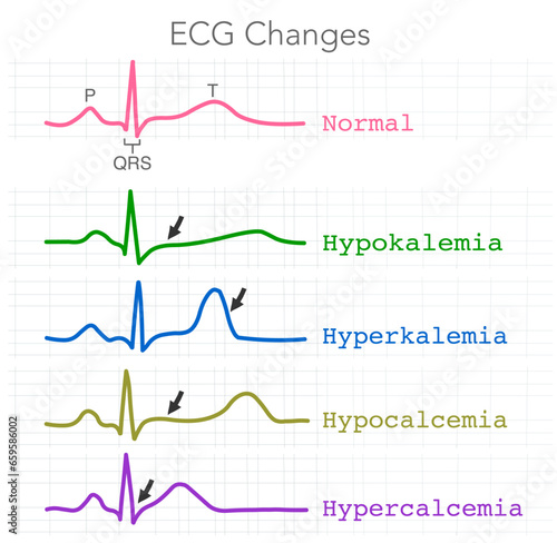 ECG changes. Hypokalemia, Hyperkalemia, Hypercalcemia, Hypocalcemia. Cardiac rhythm. Hearth beat atrial fibrillation. T colored wave p. QRS complex. Illustration vector