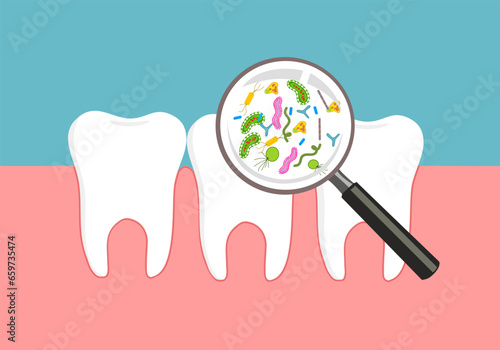 The most common bacteria associated with dental cavities are the mutans streptococci, most prominently Streptococcus mutans and Streptococcus sobrinus. photo