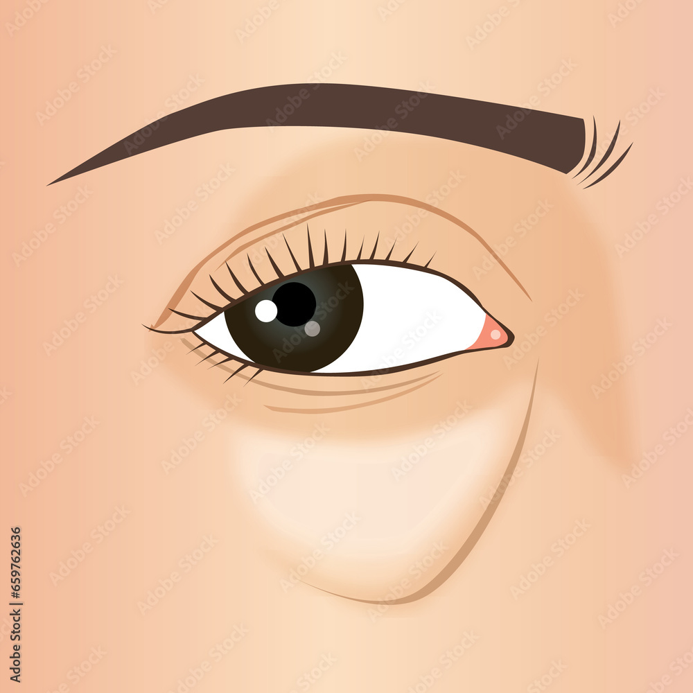 Puffy eye bag close up of aging woman's face, illustration Puffy eye bag close up of aging woman's face, illustration