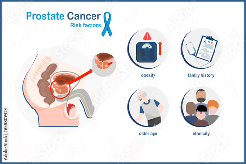 Vector medical illustration in flat style, concept of prostate cancer, prostate cancer risk factors, including elderly, ethnicity, family history,obesity.isolated on white background.