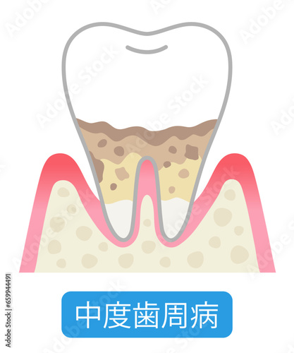 中度歯周病