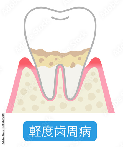 軽度歯周病