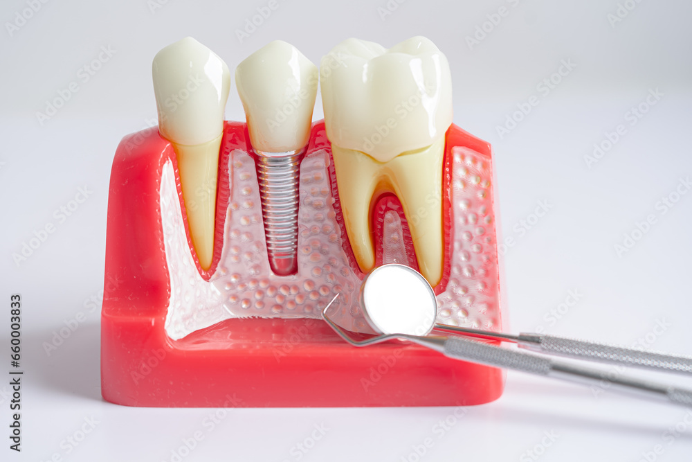 Dental implant, artificial tooth roots into jaw, root canal of dental