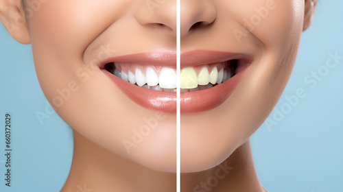 Collage Teeth before and after care, therapy and whitening. Laughing mouth of a woman with perfectly white teeth before and after. Hygiene and dental care. dentistry and teeth whitening concept.