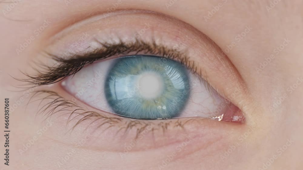 Cataract of human eye. Defect of transparency of the cornea Cataract of human eye. Defect of transparency of the cornea