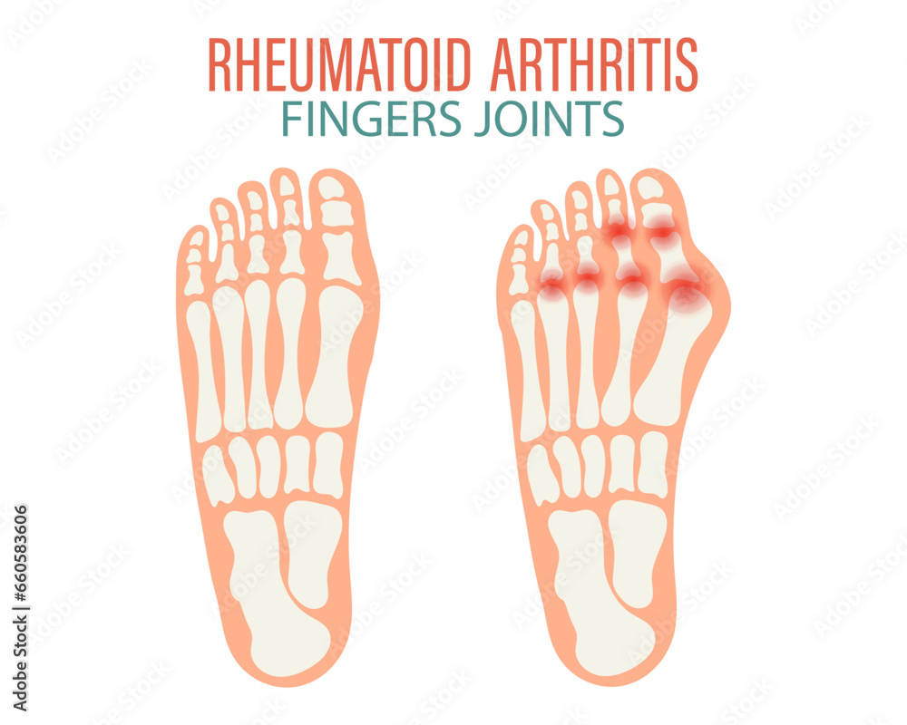 Rheumatoid arthritis icons. Knee joint, shoulder joint, wrist joint, hip joint, foot joint. Types of arthritis. Medical concept. Vector Rheumatoid arthritis icons. Knee joint, shoulder joint, wrist joint, hip joint, foot joint. Types of arthritis. Medical concept. Vector