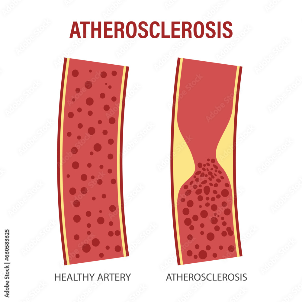 Healthy and atherosclerotic vessels with blood cells. Cholesterol in ...