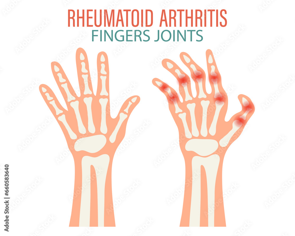 Rheumatoid arthritis icons. Knee joint, shoulder joint, wrist joint, hip joint, foot joint. Types of arthritis. Medical concept. Vector Rheumatoid arthritis icons. Knee joint, shoulder joint, wrist joint, hip joint, foot joint. Types of arthritis. Medical concept. Vector