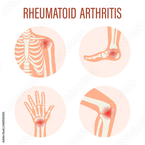 Rheumatoid arthritis icons. Knee joint, shoulder joint, wrist joint, hip joint, foot joint. Types of arthritis. Medical concept. Vector