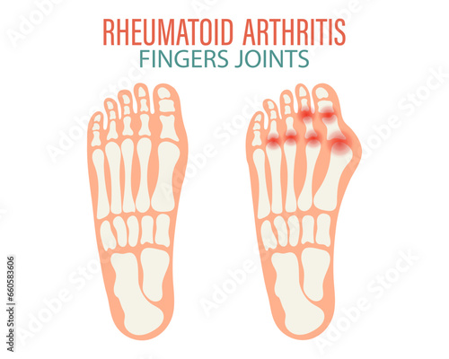Rheumatoid arthritis icons. Knee joint, shoulder joint, wrist joint, hip joint, foot joint. Types of arthritis. Medical concept. Vector