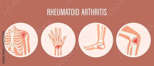 Rheumatoid arthritis icons. Knee joint, shoulder joint, wrist joint, hip joint, foot joint. Types of arthritis. Medical concept. Vector