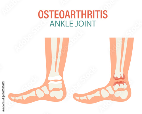 Rheumatoid arthritis icons. Knee joint, shoulder joint, wrist joint, hip joint, foot joint. Types of arthritis. Medical concept. Vector