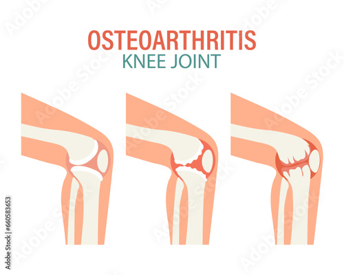 Rheumatoid arthritis icons. Knee joint, shoulder joint, wrist joint, hip joint, foot joint. Types of arthritis. Medical concept. Vector