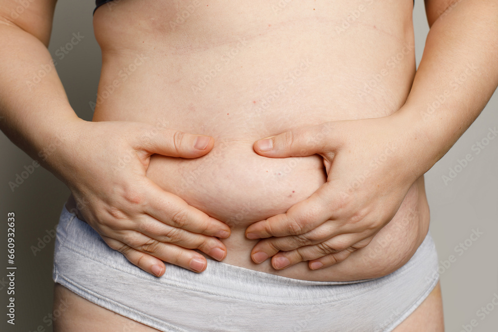 Stretch mark on skin. Woman showing stretch marks on the lower abdomen Stretch mark on skin. Woman showing stretch marks on the lower abdomen